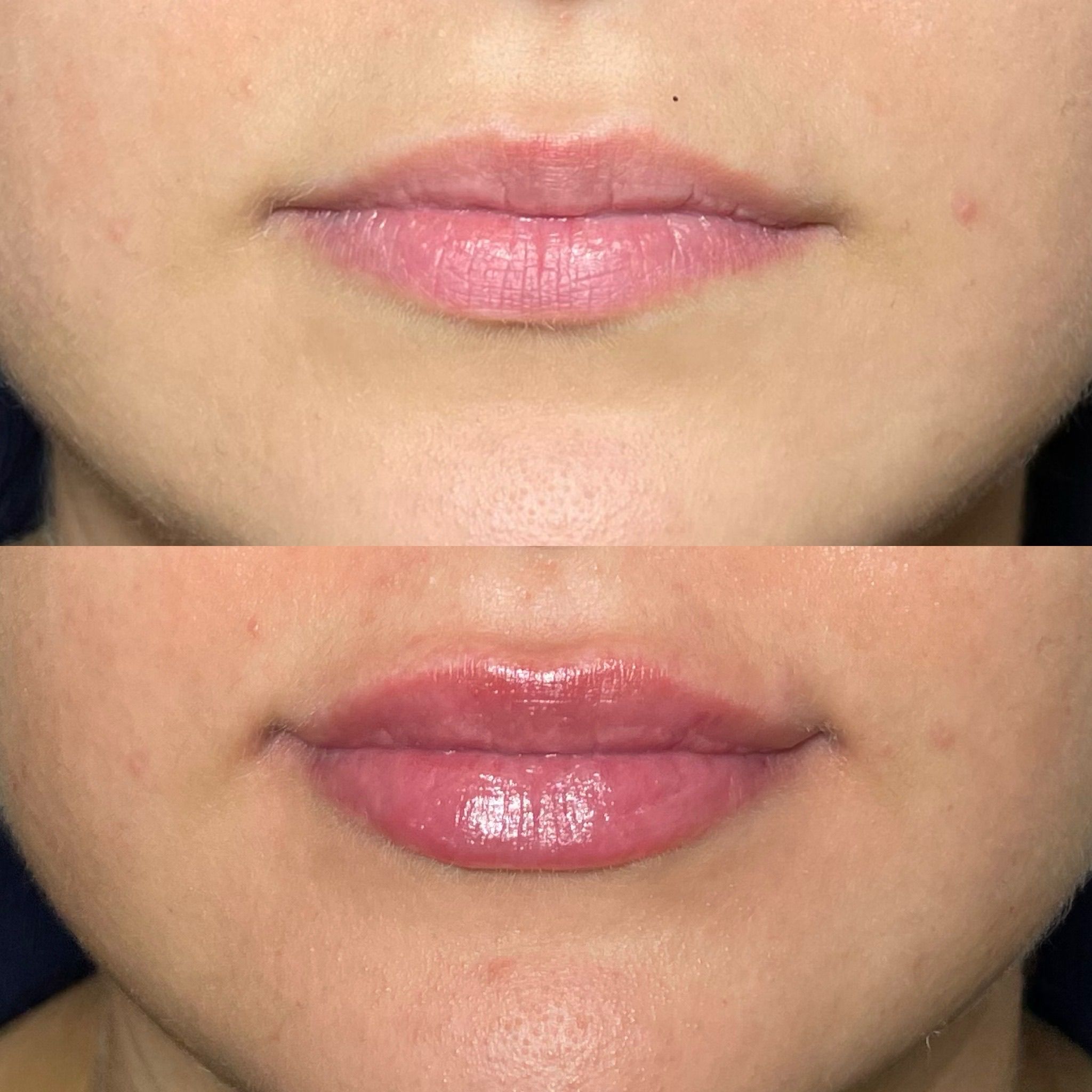 Lip Filler London – Natural Lip Enhancement & Lip Augmentation